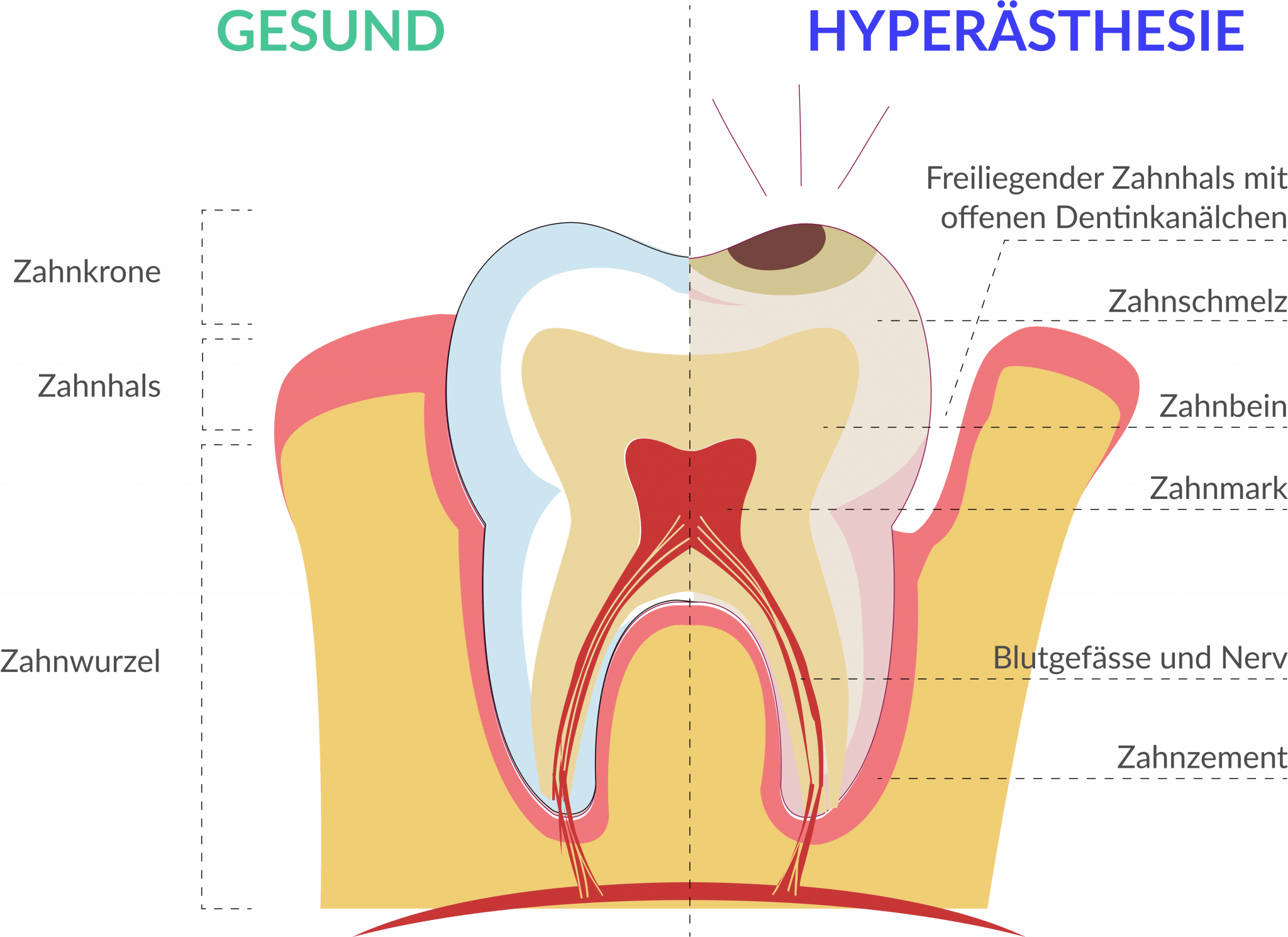 gesund und Zähne mit Hyperästhesie