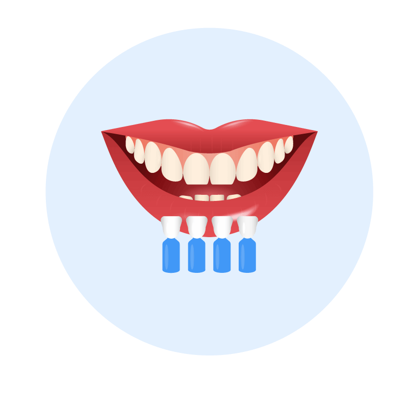 Definition von Farbe und Form der erforderlichen Veneers