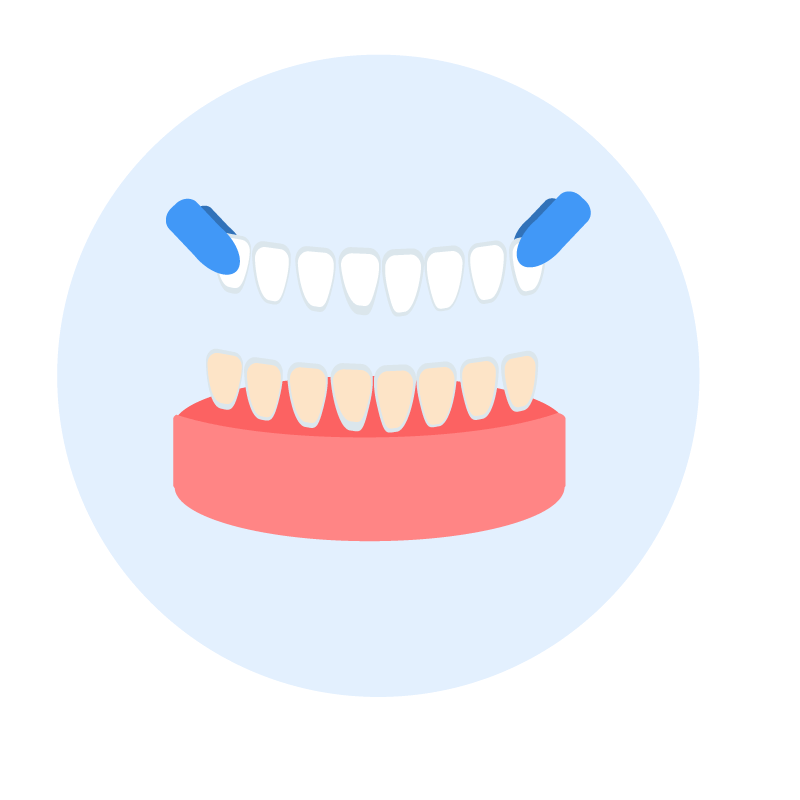 Fixierung von temporären Veneers
