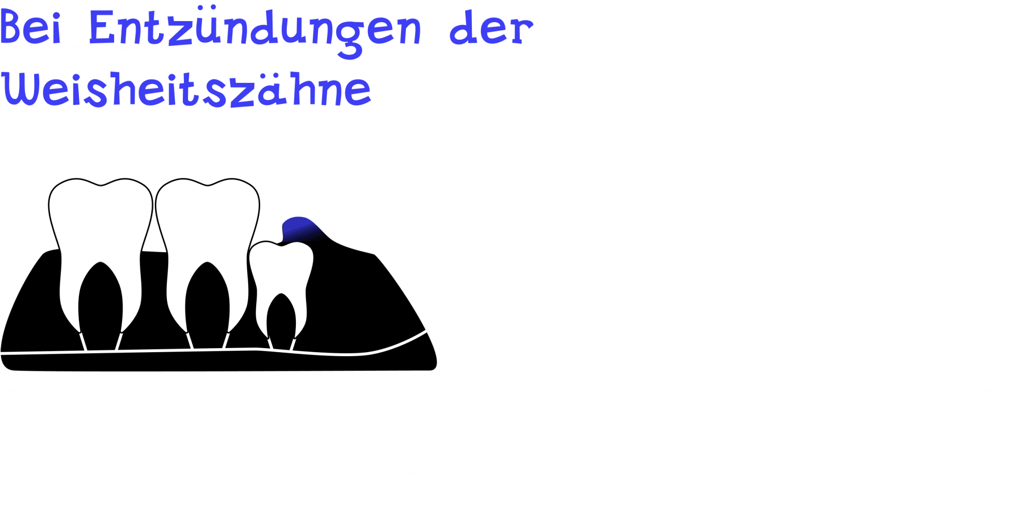 Bei Entzündungen der Weisheitszähne