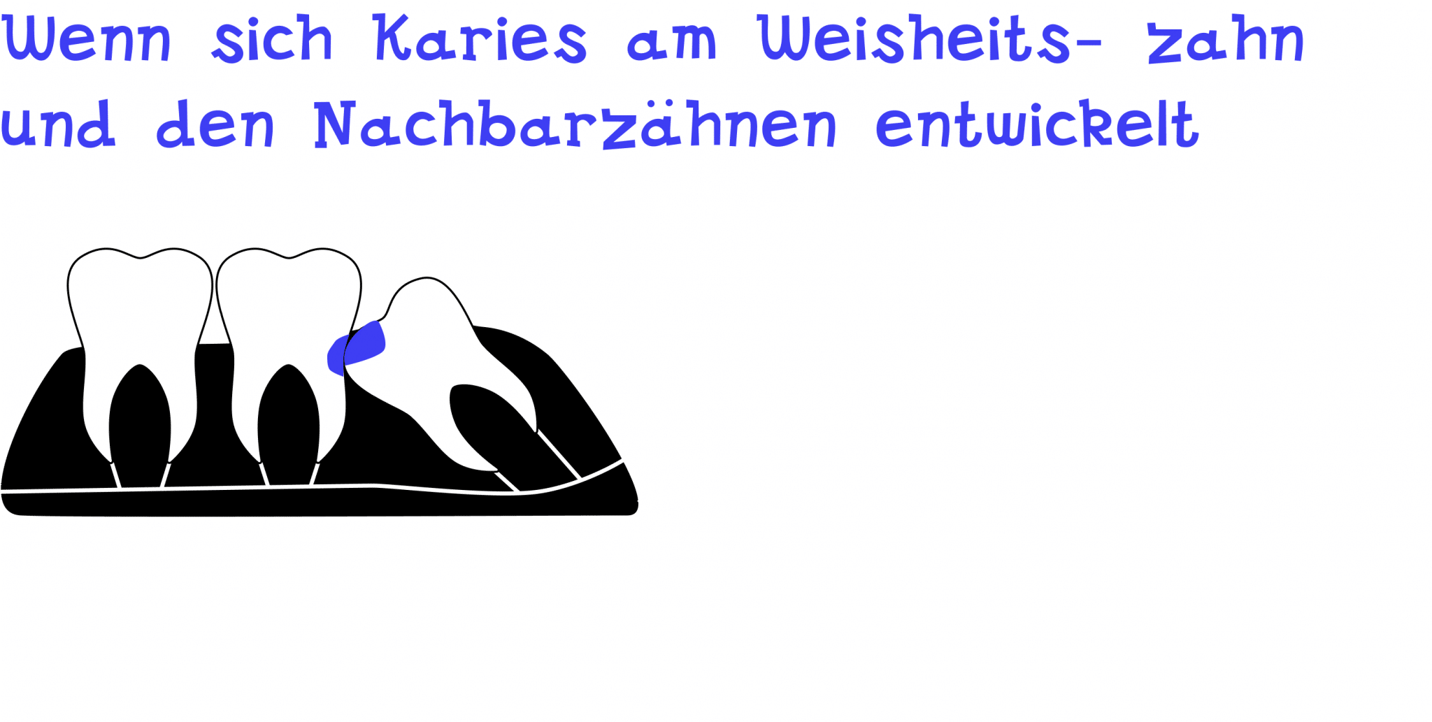 Wenn man Karies am Weisheitszahn und den Nachbarzähnen hat