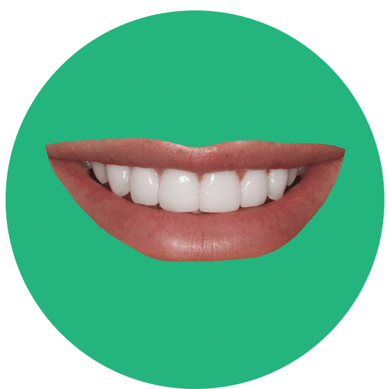 Keramik Veneers Nachher