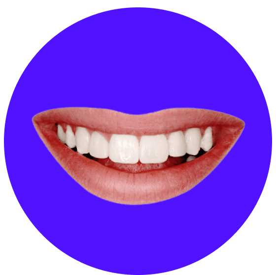 Komposit-Veneers Nachher