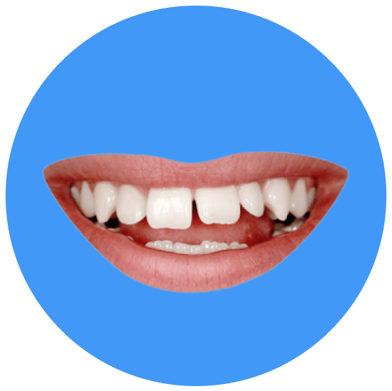 Komposit-Veneers Vorcher