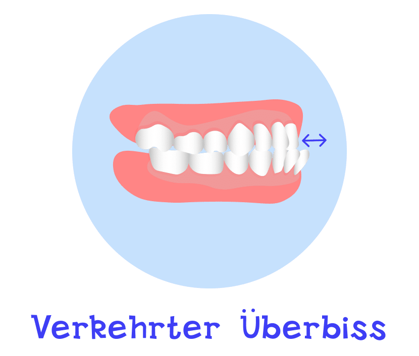 Verkehrter Überbiss