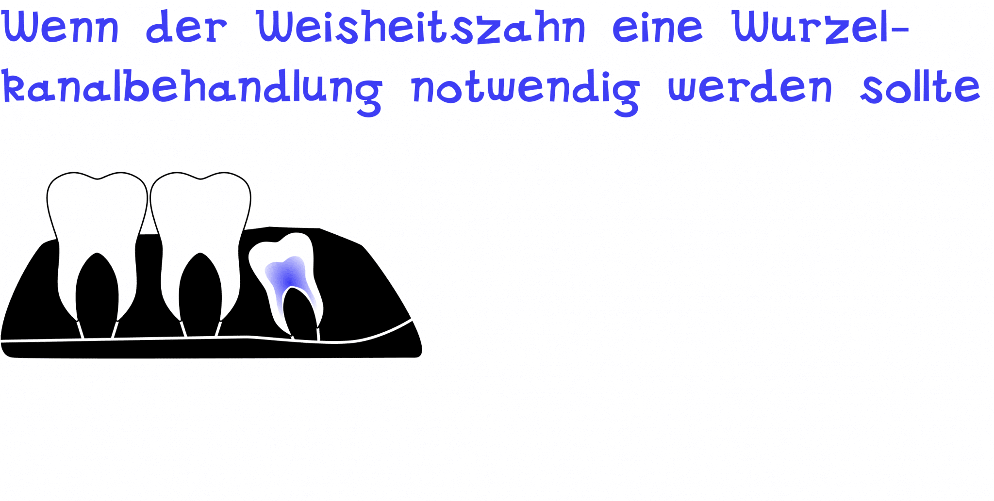 Wenn der Weisheitszahn eine Wurzelkanalbehandlung benötigt