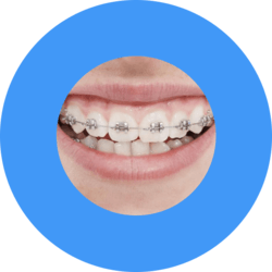 Zahnpasta für Zähne mit der Zahnspange