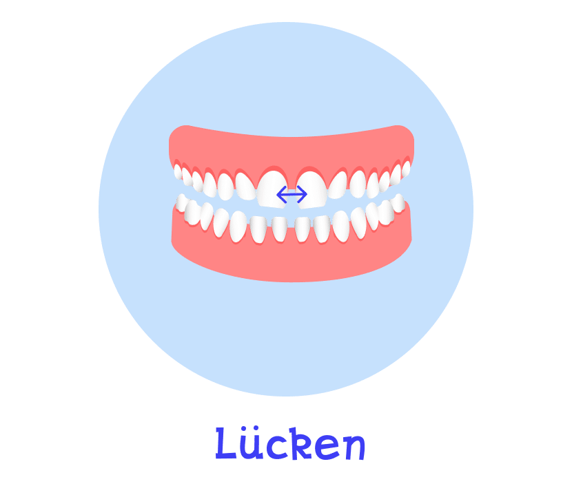 Lücken