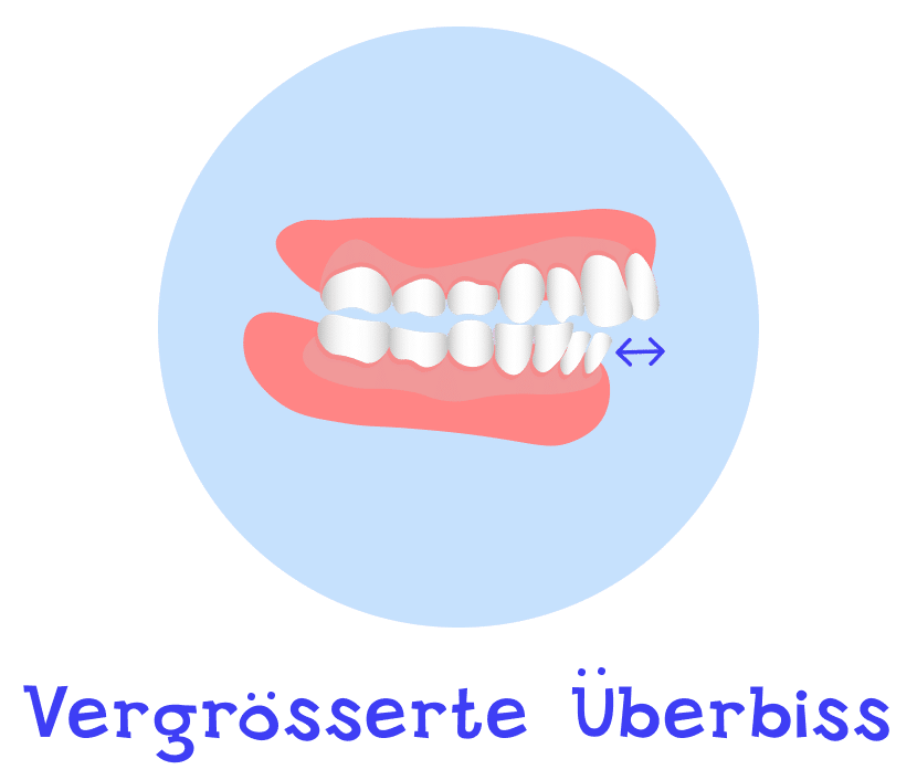 Vergrösserter Überbiss