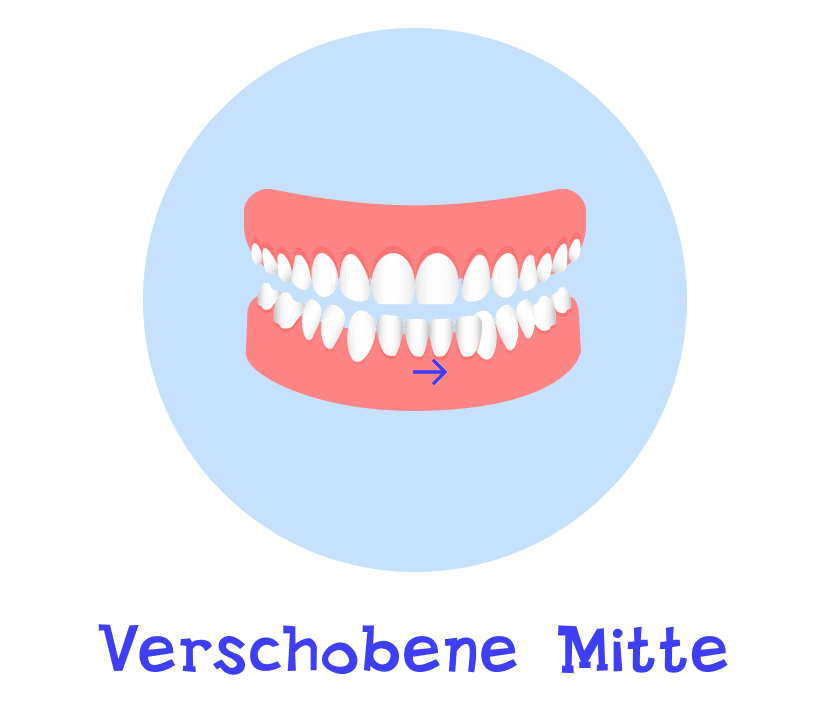 Verschobener Mitte