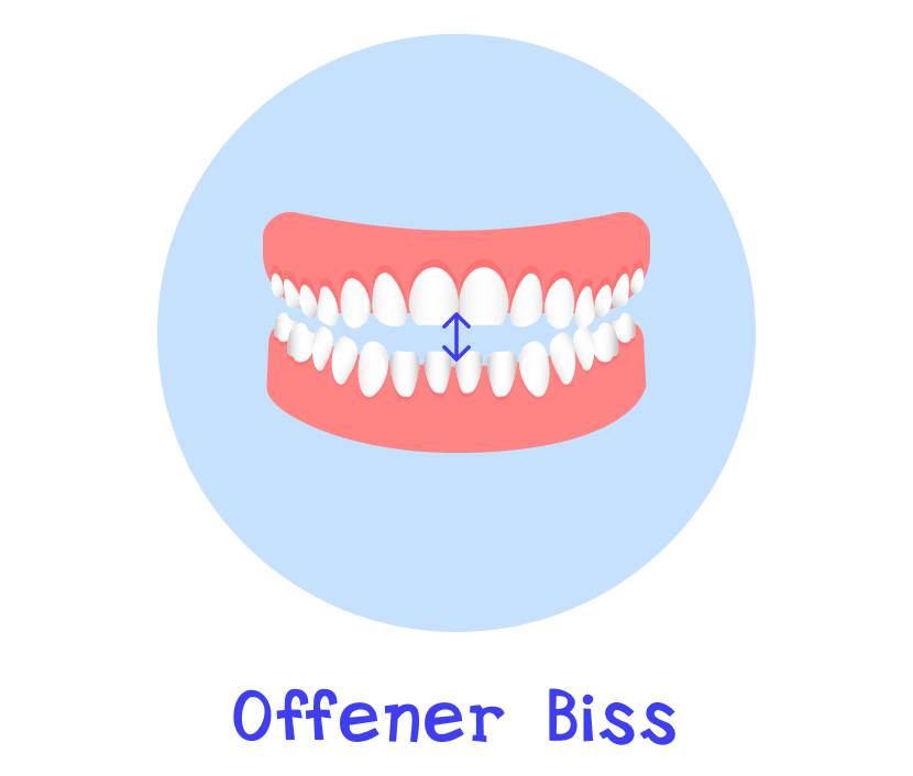 Offenen Biss