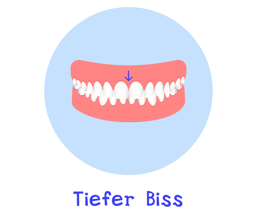 Tiefen Biss