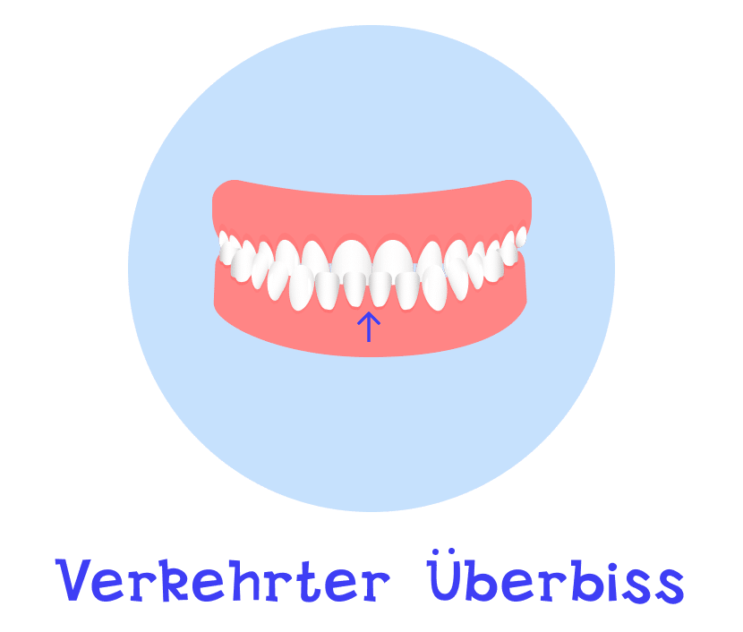 Verkehrten Überbiss