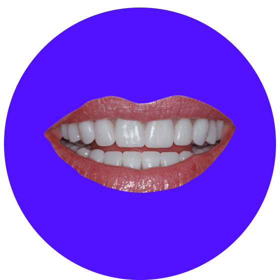 Zirkonium-Veneers Nachher
