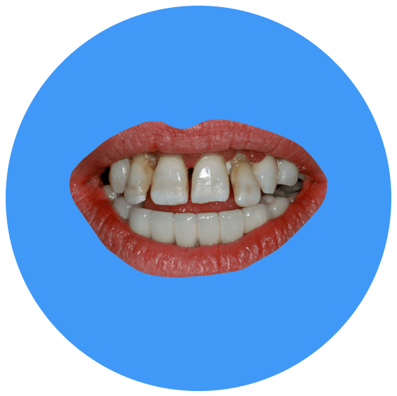 Zirkonium-Veneers Vorcher