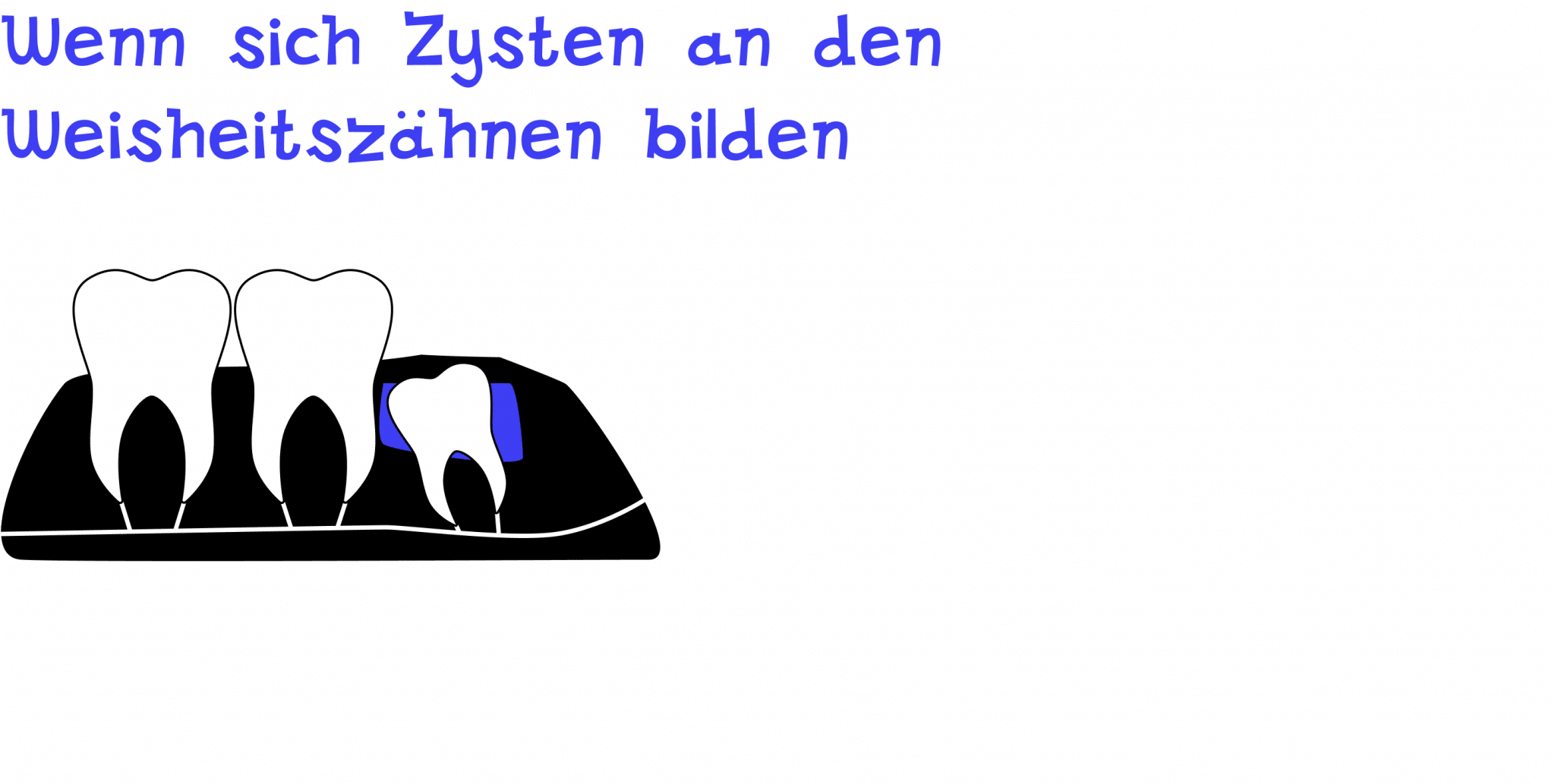Wenn Zysten an den Weisheitszähnen sind