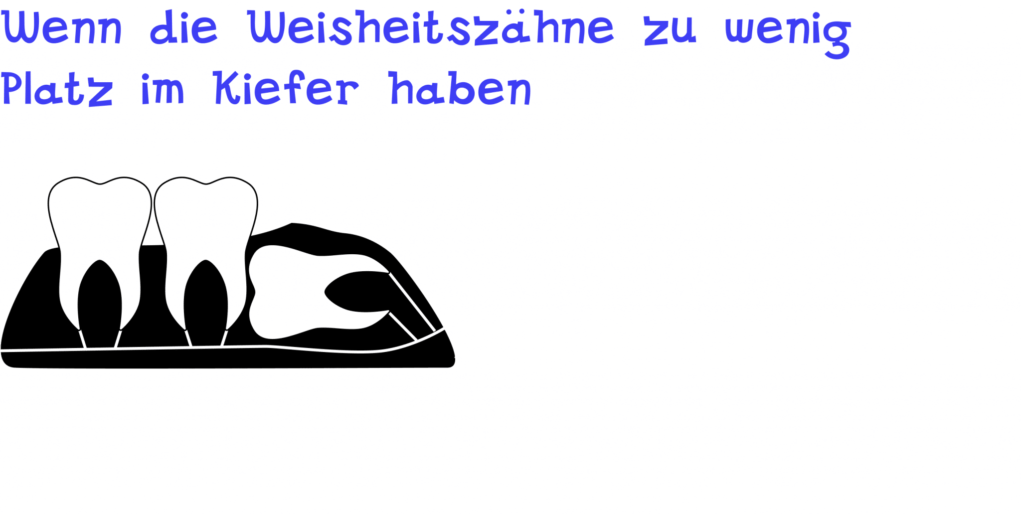 Wenn die Weisheitszähne zu wenig Platz im Kiefer haben